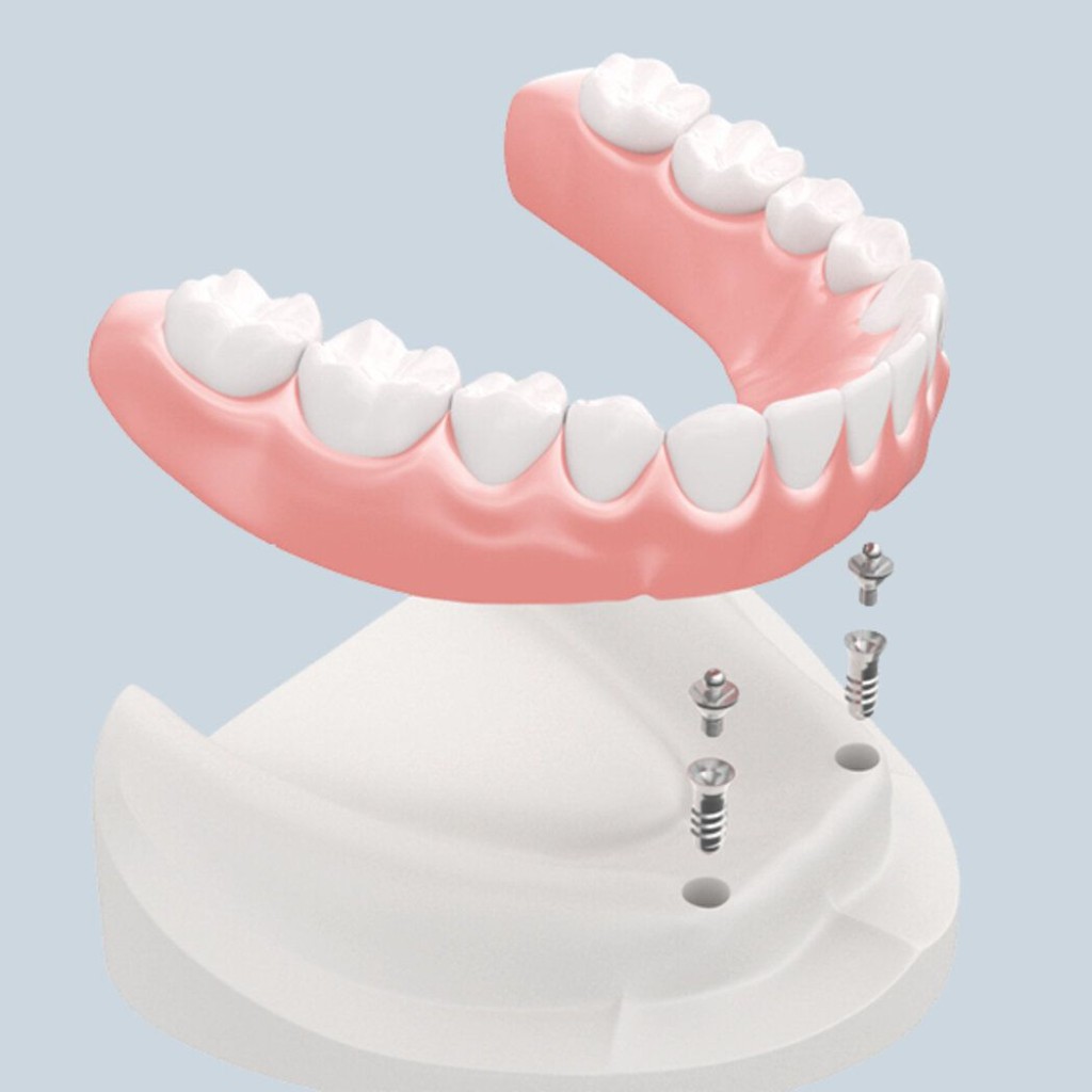 Illustratie van een klikgebit op implantaten